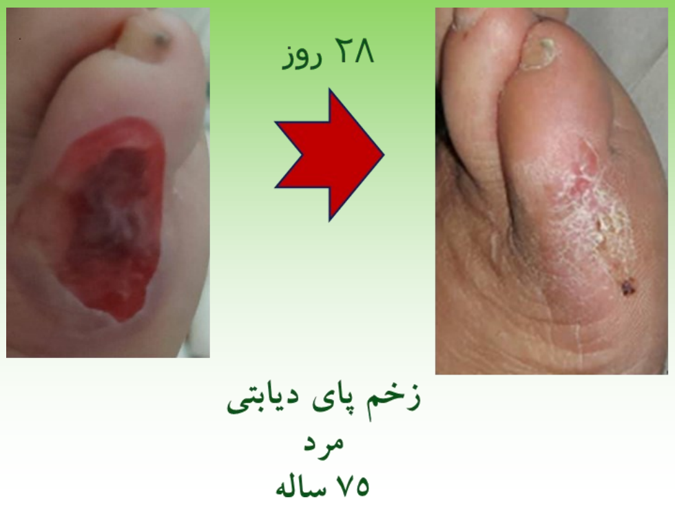 نمونه ترمیم شده زخم پای دیابتی با اسپری رژفادرم بیمار اقا 75 ساله پس از 28 روز