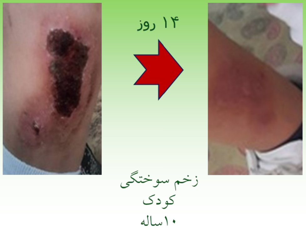نمونه ترمیم شده زخم سوختگی با اسپری رژفادرم بیمار کودک 10 ساله پس از 14 روز
