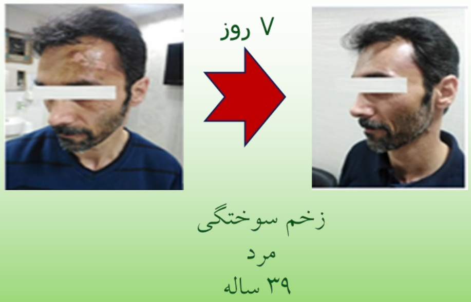 نمونه ترمیم شده زخم سوختگی با اسپری رژفادرم بیمار اقا 39 ساله پس از 7 روز