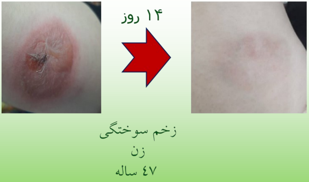 نمونه ترمیم شده زخم سوختگی با اسپری رژفادرم بیمار زن 47 ساله پس از 14 روز